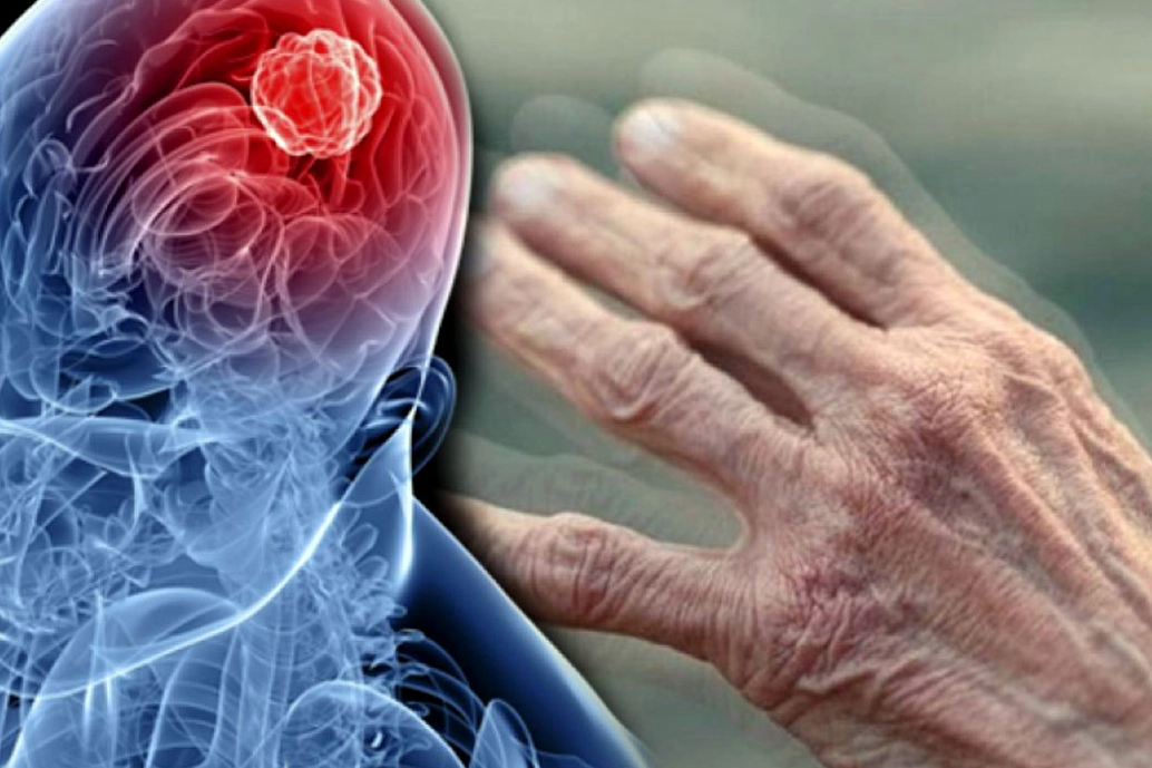 Parkinson Hastalığında Çevresel Riskler Gündemde